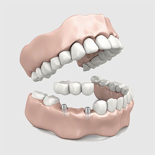 Dental Bridges | Smile Line Dental | Dentist Caroline Springs