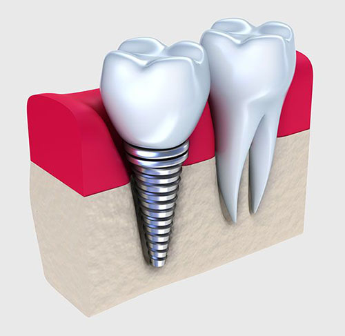 http://www.smilelinedental.melbourne/wp-content/uploads/2016/06/Dental-Implant-Smile-Line-Dental-Dentist-Caroline-Springs.jpg