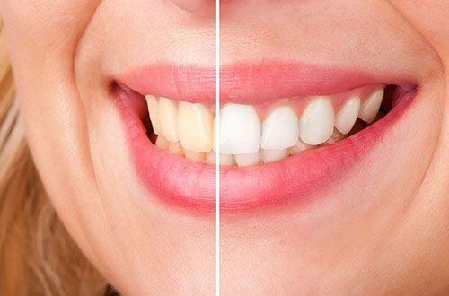 Teeth Whitening | Smile Line Dental | Dentist Caroline Springs