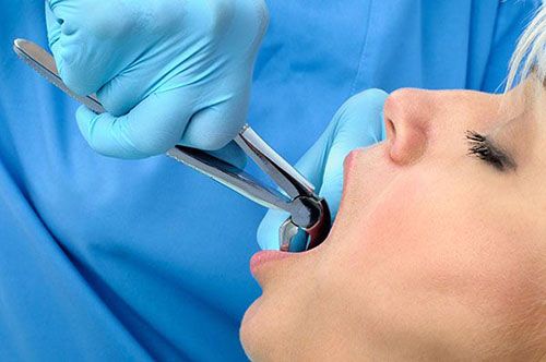 Tooth Extractions | Smile Line Dental | Dentist Caroline Springs