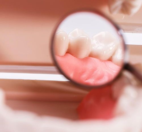 Tooth Fillings | Smile Line Dental | Dentist Caroline Springs